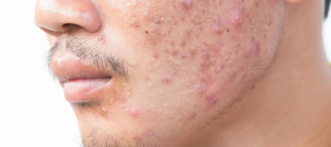 دلایل بروز آکنه